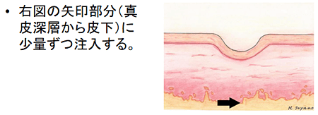 注入の深さと量（ボトックスとポリ乳酸）