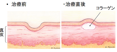 注入の深さと量（コラーゲン）