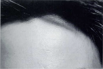 前額部のしわ。治療前