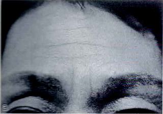 額および眉間のしわ。治療前。Zyderm® IIを注入した