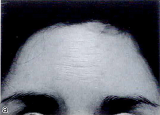 額のしわ。高研アテロコラーゲン・インプラントを注入した