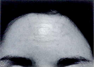 治療後。日光過敏による発赤と腫脹が認められる