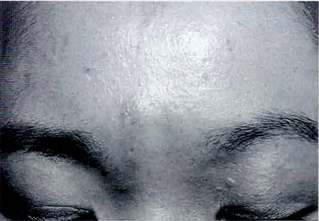 Zyderm® II 注入後の遅延型アレルギー反応。