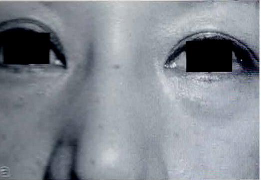 38歳女性。下眼瞼の陥凹。高研アテロコラーゲン・インプラントで治療を行った