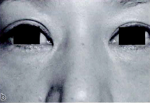 療2週間後。良好な結果が得られた。