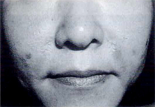 症例8 33歳女性。鼻唇溝にZyderm® IIを注入後、遅延型アレルギー反応を認めた。