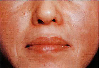 鼻唇溝の治療前