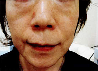 鼻唇溝から口角のたるみが若干改善している