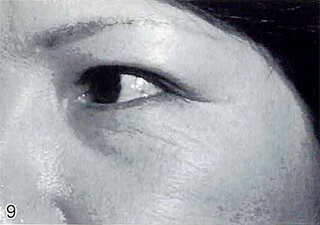 下眼瞼（したまぶた）のしわ。Zyderm I® およびアテロコラーゲン® による治療前。