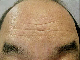 額右半分を Esthelis® Basic（Anteis 社，スイス）で治療する前