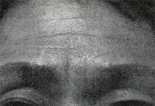 額と眉間の皺/治療前/Zyderm IIを注入