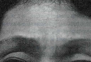 治療2週後/眉間と額の皺は浅くなった