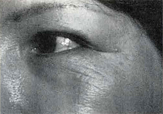 目尻と下眼瞼の皺/治療前/目尻には ZydermIを下眼瞼には Atelocollagen 1% を注入