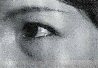 治療2週後/目尻と下眼瞼の皺は浅くなった