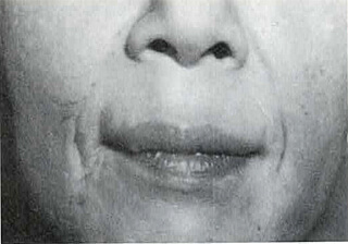 鼻唇溝の皺の治療前/注入部位は青く点をつけている/Cosmoplastを注入