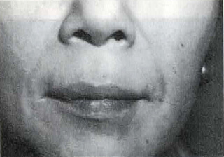 治療2週後/鼻唇溝の皺は浅くなった