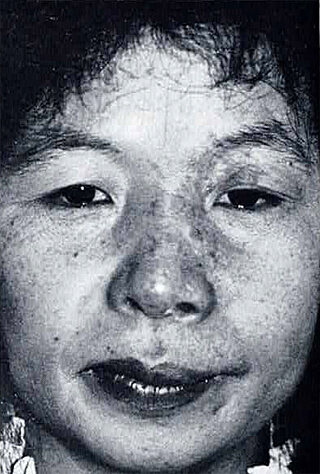 照射後1年 判定は良